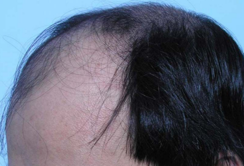 男人37头顶脱发怎么办？